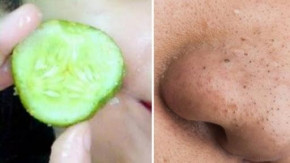 Cồi mụn đầu đen trồi lên ầm ầm chỉ với 1 lát dưa chuột chấm đường vừa rẻ vừa tiện có sẵn trong nhà bếp