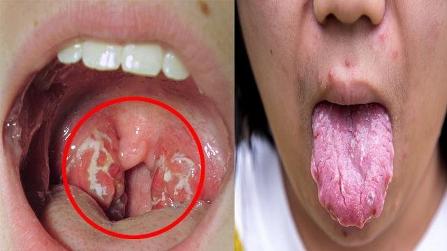 Phụ nữ tiếp tục ăn uống thế này thì nói sao mắc bệnh ung thư vòm họng, ung thư vú nhé