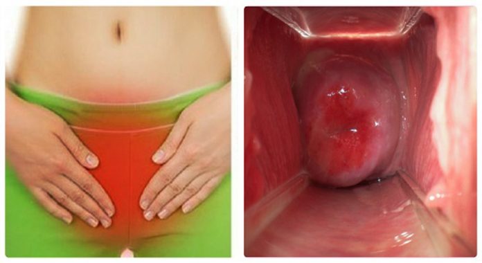 Thấy 4 dấu hiệu này ở vùng kín, các chị hãy lập tức đi khám ngay, đừng chần chừ!