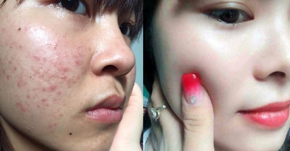 Chỉ cần bạn thực hiện đúng các bước sau là mụn sẽ mau xẹp và không tái phát
