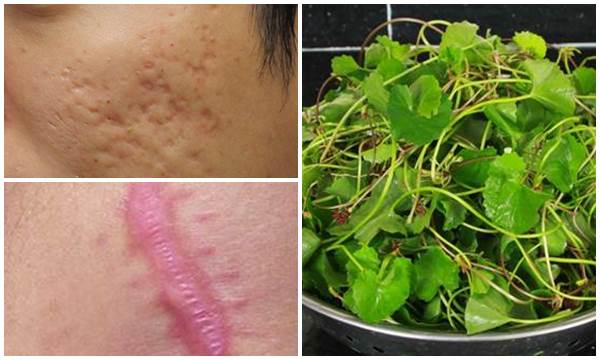 Độc chiêu xóa sạch sẹo lồi bằng nắm rau má rẻ bèo chỉ sau vài lần dùng