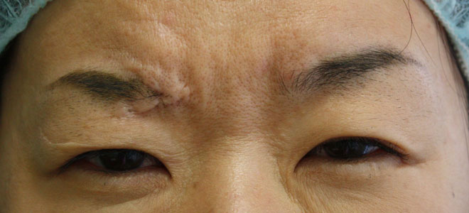 CÁCH HỆU QUẢ ĐỂ LOẠI BỎ NẾP NHĂN TRÊN MẶT