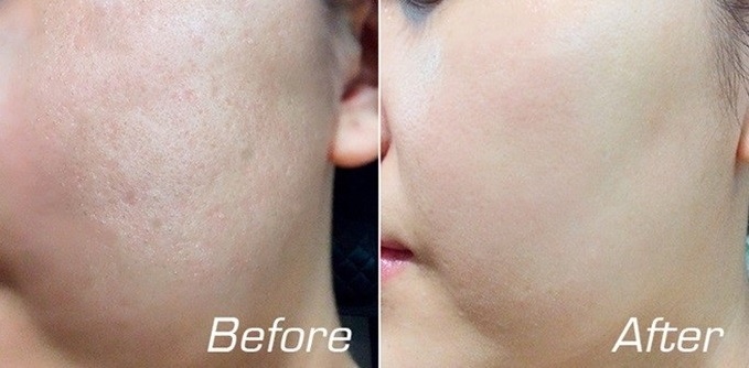 Da MẶT LỘT TRẮNG như trứng gà bóc sau 4 tuần nhờ dùng viên E theo cách này, tốn tiền triệu đi spa cũng chẳng bằng