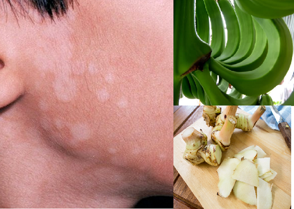 Chia sẽ ngay 4 cách trị lang ben tận gốc đáng kinh ngạc ngay tại nhà