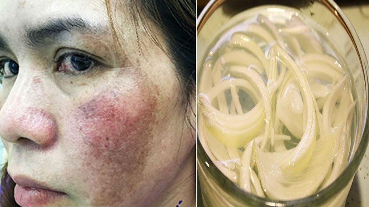 Nám, tàn nhang lâu năm cũng hết sạch nhờ 3 công thức đơn giản từ hành tây