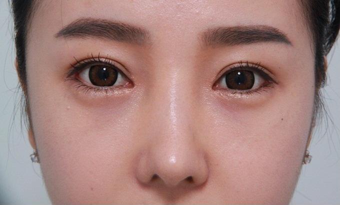 Thức xuyên đêm mà sáng ra vẫn tươi rói, không một vết thâm quầng chỉ nhờ 1 thìa muối trắng