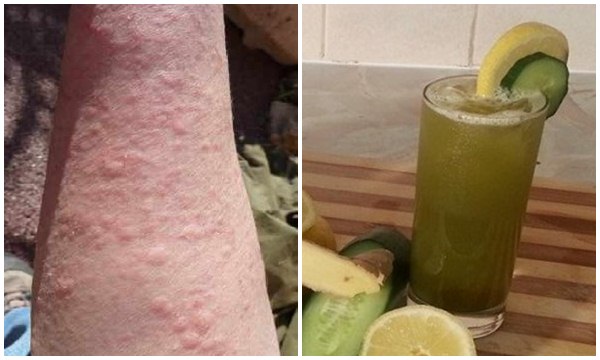 Hết dị ứng chỉ với 1 ly nước, cùng lưu lại để áp dụng khi cần