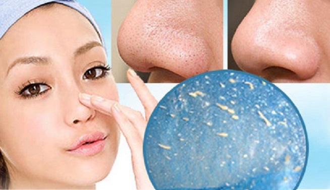 Cách trị mụn cám vùng 2 bên cánh mũi với biện pháp đơn giản không tốn kém