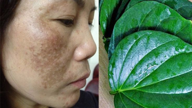 Phương pháp “dễ ợt” trị tàn nhang cho da mịn láng