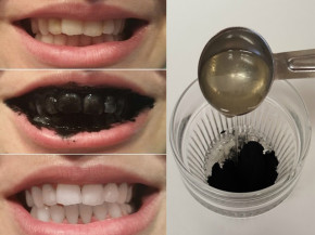 Mẹo tẩy trắng răng bằng than hoạt tính hiệu quả, an toàn để đón Tết