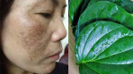 Phương pháp “dễ ợt” trị tàn nhang cho da mịn láng