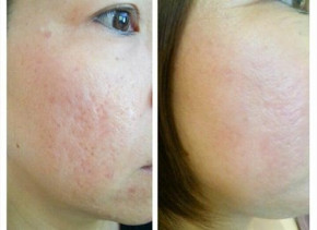 Không cần vội đi thẩm mỹ, em mách các chị 2 công thức trị mặt rỗ, sẹo lõm đã được nghiên cứu đây