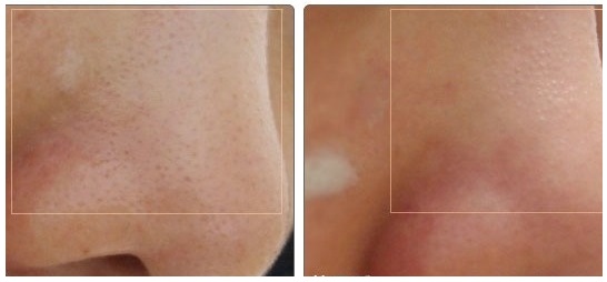 Chỉ bạn cách lấy mụn đầu đen sâu dưới da mà không làm to lỗ chân lông