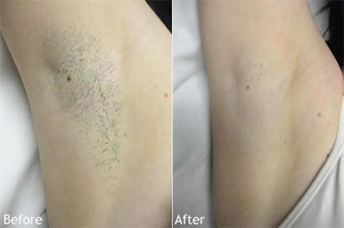 Trị thâm nách tự tin diện áo 2 dây "sẹc xy" với công thức chưa đến 10k