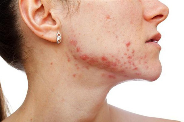 Dù kết hợp với nguyên liệu nào VỚI MẬT ONG cũng có thể chế ra “THẦN DƯỢC” TRỊ MỤN SIÊU HIỆU QUẢ