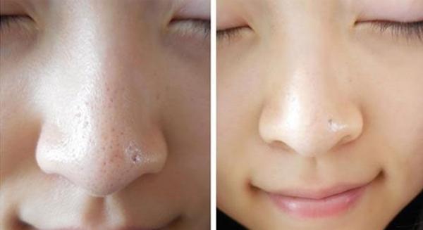 Thu nhỏ lỗ chân lông mãi mãi bằng những nguyên liệu nhà nào cũng có, chỉ sau vài ngày da mướt mịn căng bóng không ngờ!