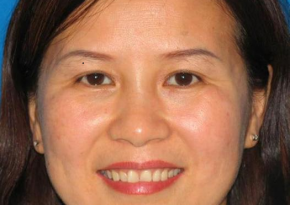 Cách TRỊ NÁM SANG CHẢNH - bí kíp để TRỊ SẠCH NÁM - niềm khát khao của phụ nữ cả nước