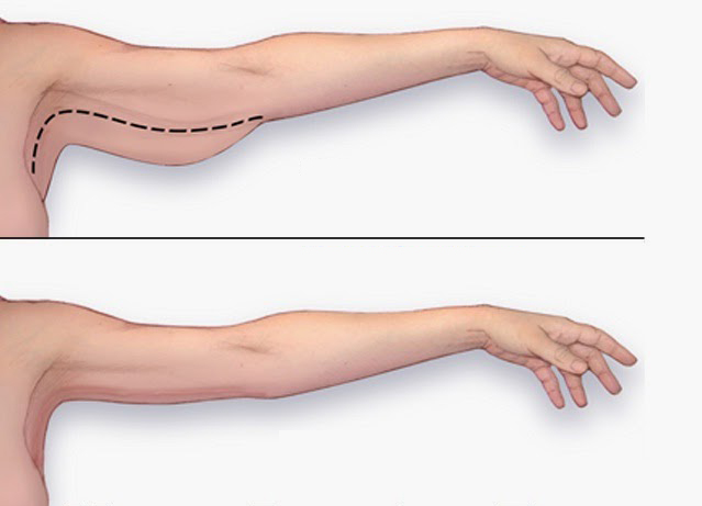 LÀM ĐẸP TIẾT KIỆM MÙA TẾT: GIẢM MỠ BẮP TAY BẰNG MUỐI – CHUYỆN THẬT HAY ĐÙA?