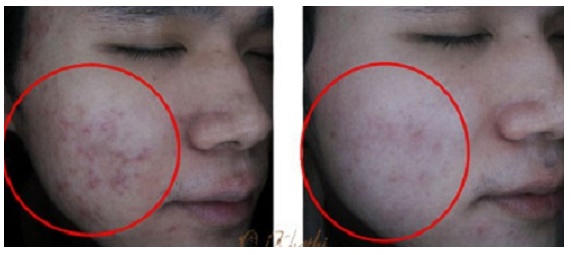 Sạch SẸO MỤN, VẾT THÂM MỤN, DA ĐẸP LÁNG MỊN chỉ với công thức đơn giản từ cây lá, nhà nào cũng có, THỬ NGAY THÔI!!!