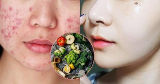 Mụn chi chít như cơm cháy cũng hết sạch sành sanh, da căng trắng bất ngờ nhờ siêng detox theo cách này!