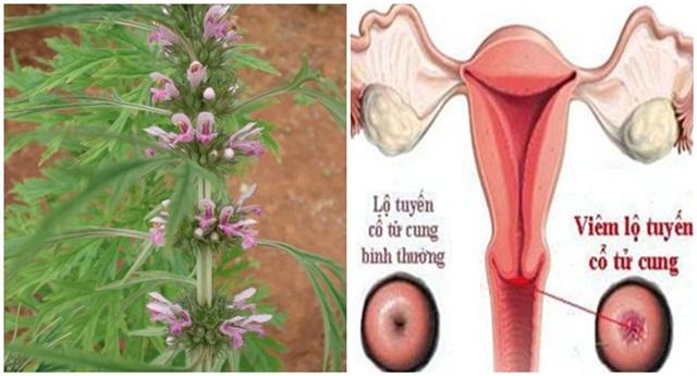 Mách chị em cách chữa khỏi VIÊM LỘ TUYẾN CỔ TỬ CUNG tại nhà chỉ trong vài tuần, từ giờ không còn SỢ phải đốt điện đau đớn gì nữa nhé