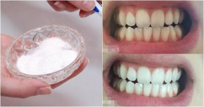 Rần rần cách làm trắng răng đón Tết ngay lập tức chỉ với 1 muỗng này, cao răng, mảng bám bong tróc, miệng thơm tho sạch sẽ