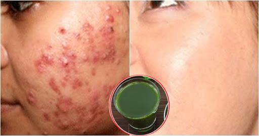 4 loại nước dù da có mụn như cơm cháy uống vào cũng láng mịn, sáng hồng ngay còn ngăn ngừa lão hóa cực hiệu quả