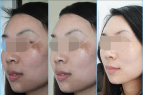 Hiểu về “NỘI CÔNG NGOẠI KÍCH” – CÁCH TRỊ NÁM DA được hàng ngàn chị em cả nước áp dụng