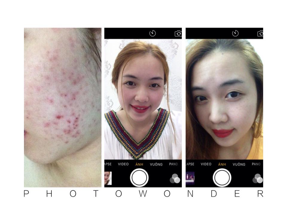 Review da trắng sau 3 tháng nhờ bộ kem dưỡng trắng phục hồi da sakura