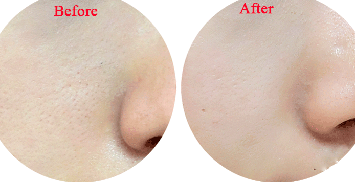 3 bước để thu nhỏ lỗ chân lông vĩnh viễn không to trở lại chỉ sau 1 tuần