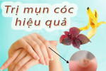 Tổng hợp 4 cách trị mụn cóc ở chân ngay tại nhà an toàn - hiệu quả khiến mụn "một đi không trở lại"