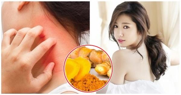 Cứu nguy cho làn da cháy nắng chỉ với 5 nghìn tinh bột nghệ rẻ bèo