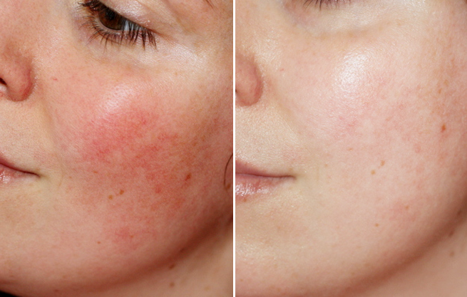 4 Loại mặt nạ dành cho da mặt mỏng giúp khôi phục và dưỡng ẩm làn da hiệu quả 100&permil;