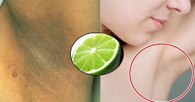 Nách THÂM ĐEN, HÔI RÌNH chỉ cần dùng bài thuốc đơn giản với CHANH cũng hết ngay dù bị bẩm sinh