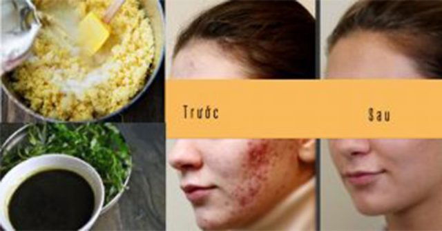 Công thức đơn giản từ cây lá, nhà nào cũng có này: Sạch bay SẸO MỤN, VẾT THÂM MỤN, DA ĐẸP LÁNG MỊN