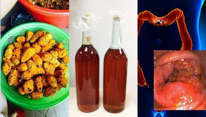 Chữa viêm đại tràng bằng nghệ và mật ong, giai đoạn mãn tính cũng khỏi hoàn toàn