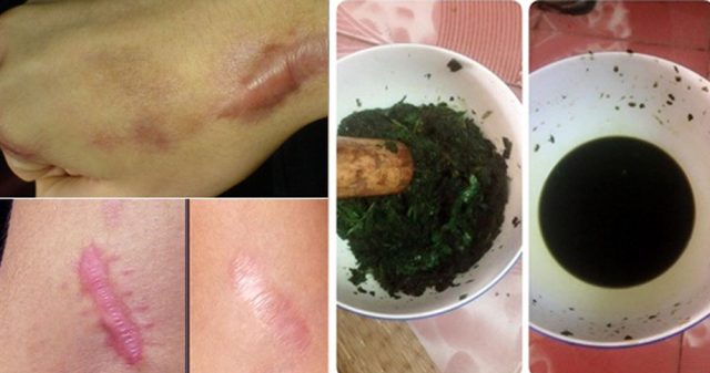 Sẹo lồi cứng đầu và lâu năm đến mấy cũng bị san phẳng tức thì, hiệu quả đến 99&permil; nhờ nhúm lá rẻ tiền bán đầy ngoài chợ