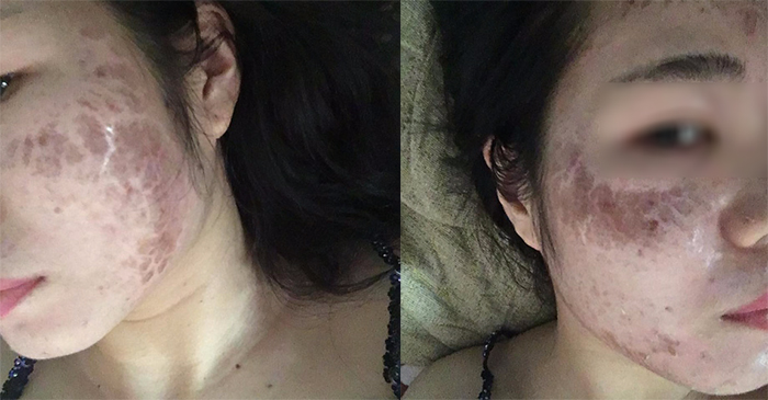 Lăn kim KHÔNG đúng cách và KHÔNG đúng tiêu chuẩn y tế có khả năng nhiễm HIV/AIDS và tổn thương da vĩnh viễn