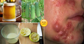 Cách trị MỤN BỌC ở cằm HIỆU QUẢ sau 1 tuần chỉ với 5k đồng, ai cũng có thể làm được!