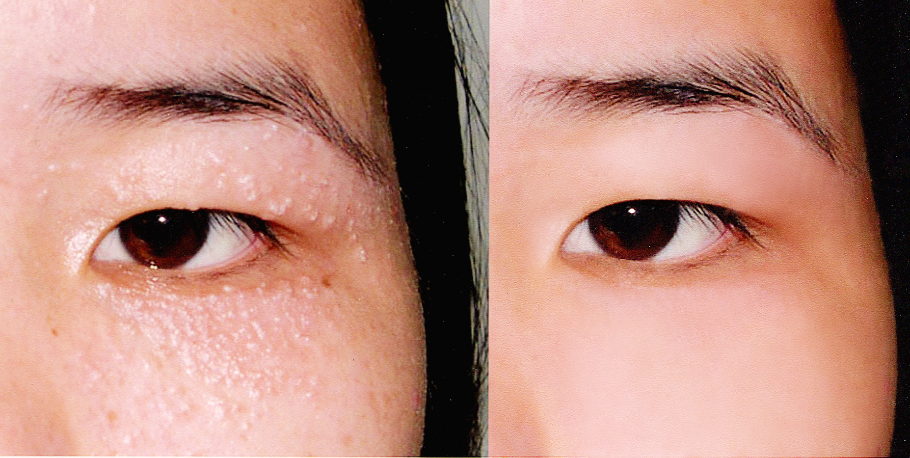 Tiêu diệt mụn thịt “một đi không trở lại” chỉ với 2000 đồng