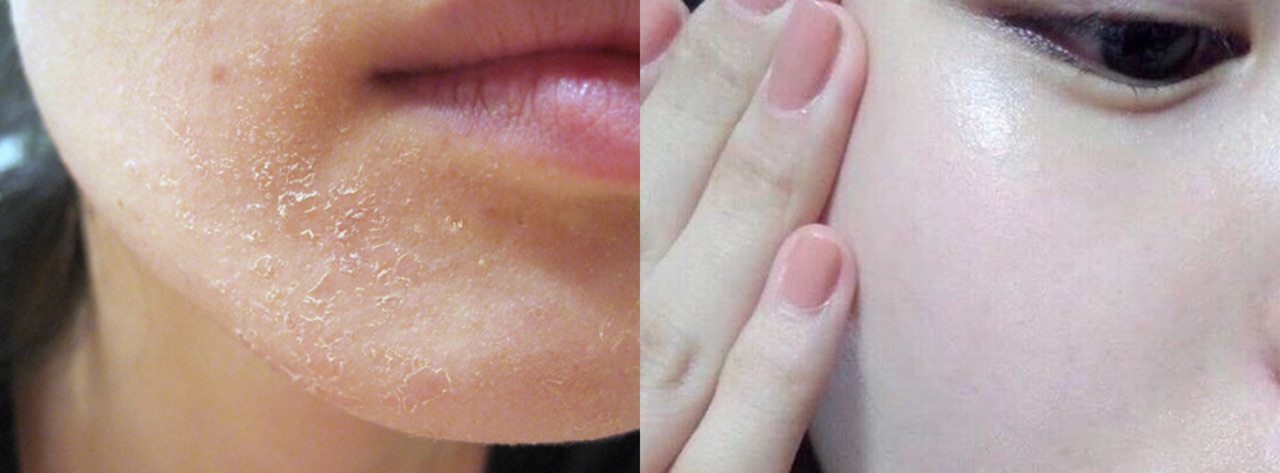 Bí quyết chăm sóc da tróc vẩy trắng thời tiết ẩm ương