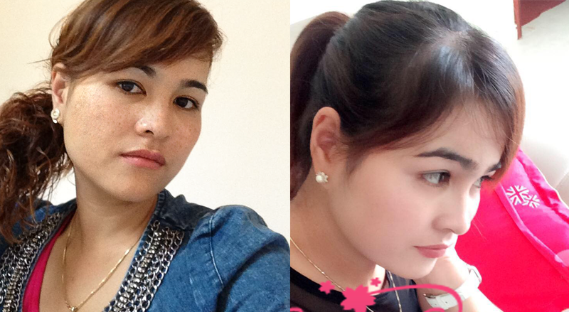 Vỏn vẹn 2 tháng điều trị, mẹ bỉm sữa xóa bỏ nám sạm da, lấy lại làn da tươi sáng, mịn màng thời con gái