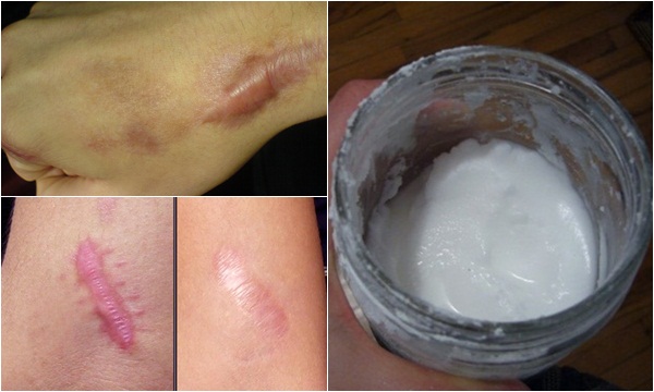 5 Mẹo đơn giản giúp LÀ PHẲNG SẸO LỒI ngay tại nhà nhanh chóng, hiệu quả