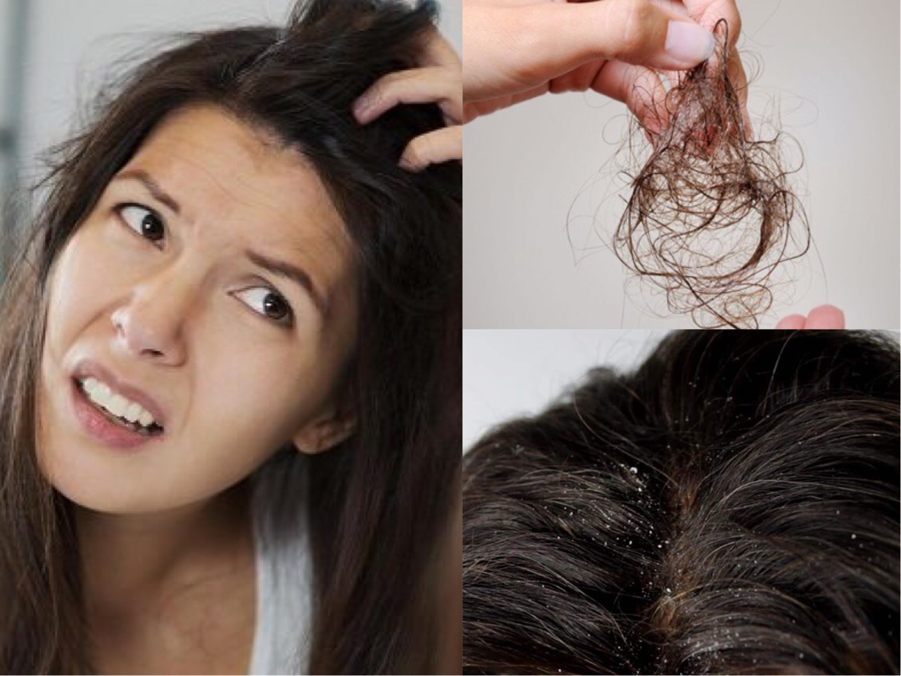 “Vị cứu tinh” trị gàu và rụng tóc vừa rẻ lại vừa hiệu quả nhanh chóng