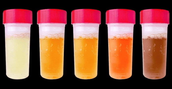 7 Màu Sắc Nước Tiểu Cảnh Báo ‘Vấn Đề Tiềm Ẩn’ Về Sức Khỏe Của Bạn