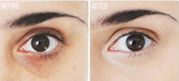 Mẹo hay đánh bay quầng thâm, bọng mắt hiệu quả với củ khoai tây