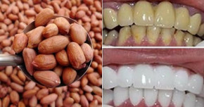 Răng trắng bóc, cao răng bong ra tức khắc chỉ nhờ nhai nhúm lạc sống rẻ tiền theo cách này