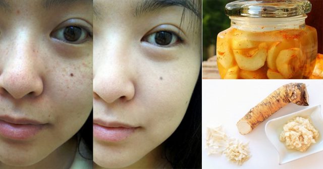 Mặt nạ thiên nhiên xóa tàn nhang SẠCH SÀNH SANH cho làn da TRẮNG HỒNG