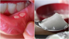 Ngậm 1 thìa này 5 phút buổi sáng, nhiệt miệng hay hôi miệng kinh niên sẽ trị dứt điểm