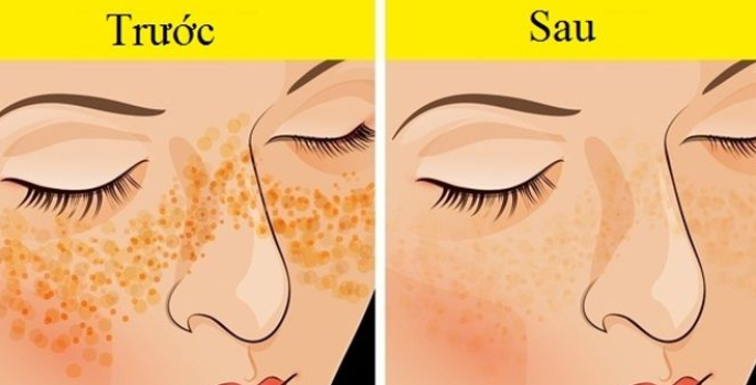 Đánh bay mụn, nám hay vết thâm bằng những mẹo đơn giản sau